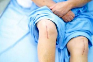Эндопротезирование коленного сустава – суть процедуры